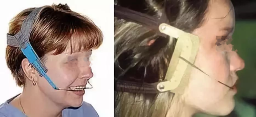 天哪!做牙齿矫正还要打钉子?我可以不矫正了吗?