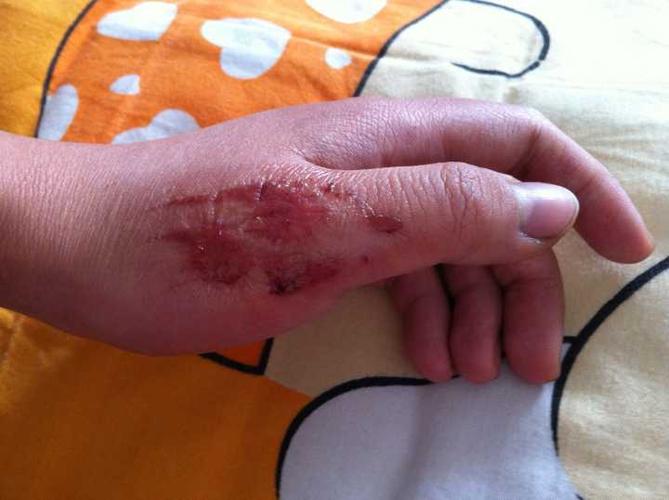 被鞭炮炸伤是种什么体验