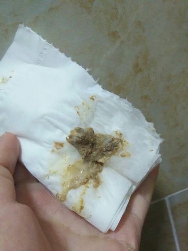 中度宫颈糜烂 白带发黄有异味去医院开的消糜栓 用五天后 发现有豆腐