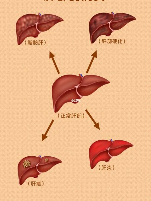 明明不胖怎么就脂肪肝了_脂肪肝_新陈代谢_减肥_医疗健康_医疗健康