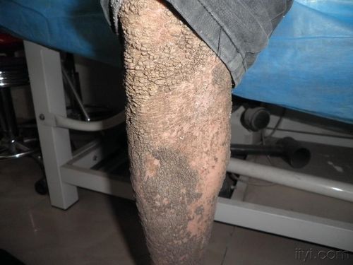 性连锁鱼鳞病 - 皮肤及性传播疾病讨论版 - 爱爱医医学论坛