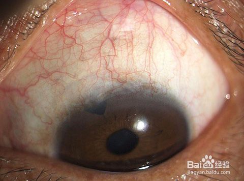 眼睛有红血丝,正常的视物可能会受到一定的影响,如果不及时的加以改善