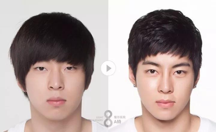 惊艳到爆!男士整容前后对比照片