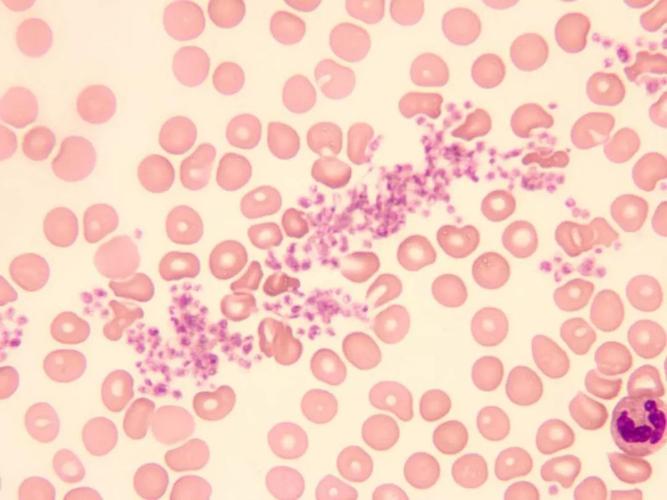 形态学报告中血小板应该如何描述|经验分享