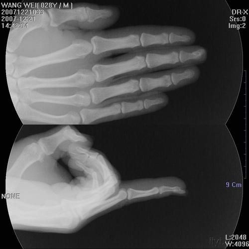 手指x光片