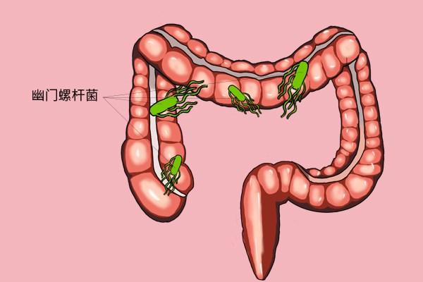 原创胃里有幽门螺杆菌,会发展成胃癌吗?消化科医生告诉你该不该根除