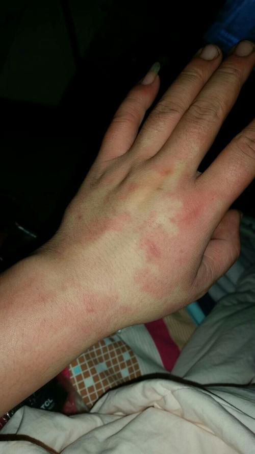 这是不是酒精过敏啊,以前没有过,今天喝完后,发现身上全是这样的红斑