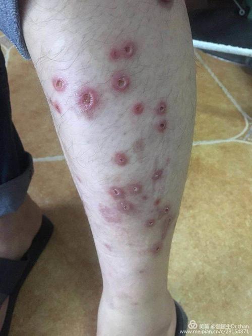 丘疹坏死性结核疹.