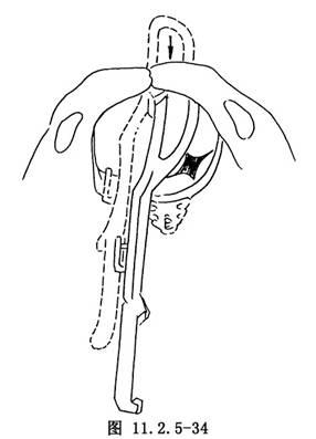 产钳术_英文_拼音_什么是产钳术_医学百科