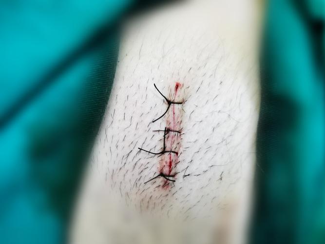 同心县人民医院泌尿外科成功开展两例显微镜下精索静脉曲张结扎术