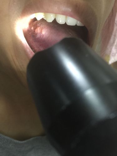 感冒好了以后,感觉嘴巴不舒服,回家照了镜子一下,舌头