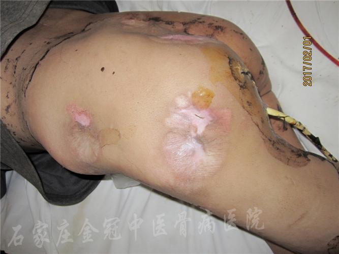 贵州省毕节市赫章县杨先生臀部褥疮多处伤口治疗