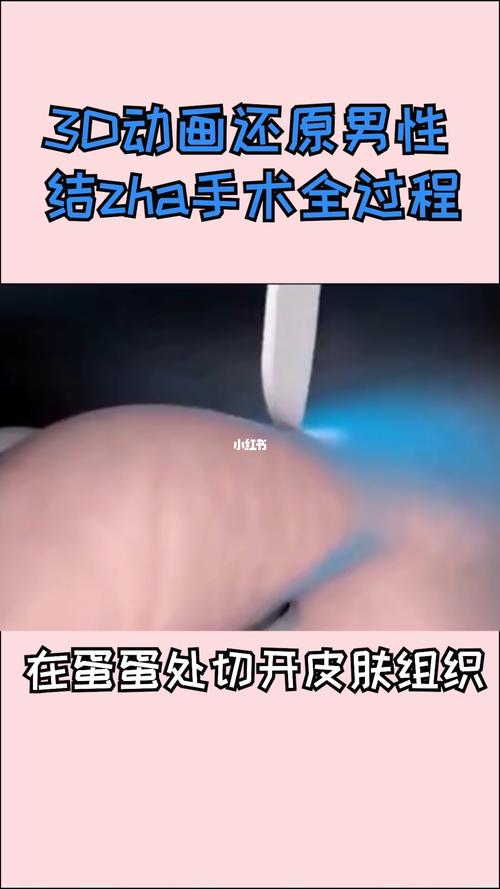 3d还原男性结扎手术全过程!_健康_医疗健康_医疗健康