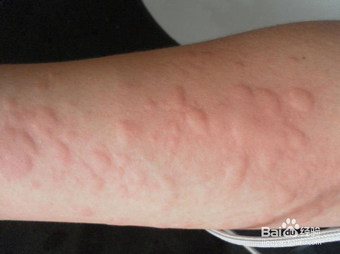 荨麻疹会有怎样的危害-百度经验