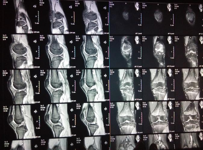 膝关节的核磁片子,半月板有损伤,自己也看不太懂,帮我