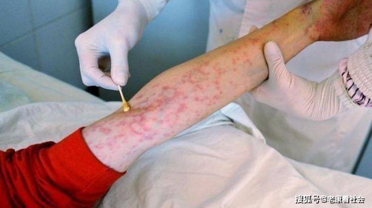 尤其是念珠菌,使皮肤出现异常症状,如皮炎或紫斑