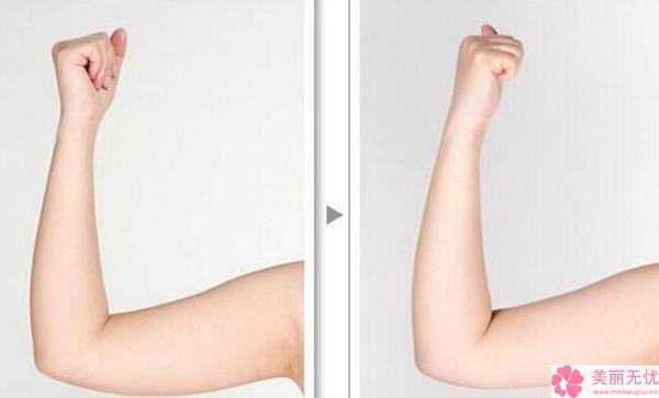 长久以来就容易聚集在手臂和肩背的位置.