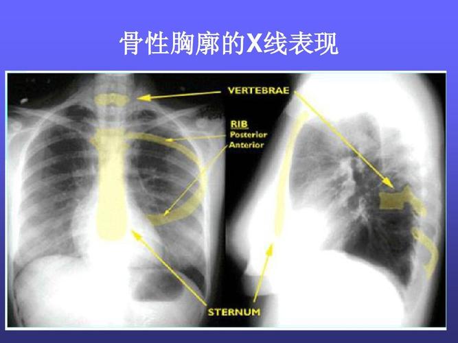 骨性胸廓的x线表现