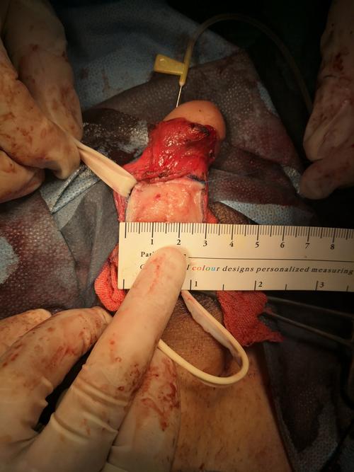 手术治疗阴茎硬结症斑块切除补片修补矫正,继续扩大手术例数!