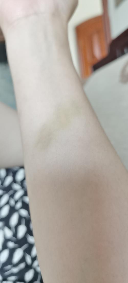 整条手臂从茶几撞过去的淤青