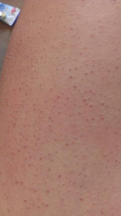 请问怎么可以把鸡皮疙瘩消掉