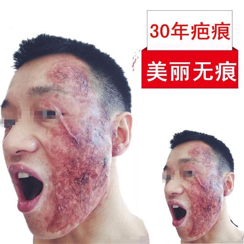 疤痕疙瘩增生剖腹产痤疮手术疤痕增生去色素凸疤疙瘩修复膏疤痕贴