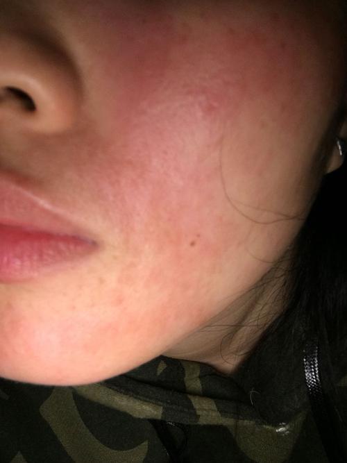 脸不知道是不是吃了牛肉,还是擦了别人的护肤品过敏啦