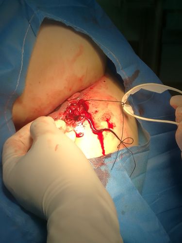 炎性肠病合并高位肛瘘手术 术者北京市肛肠医院 秦澎湃主任