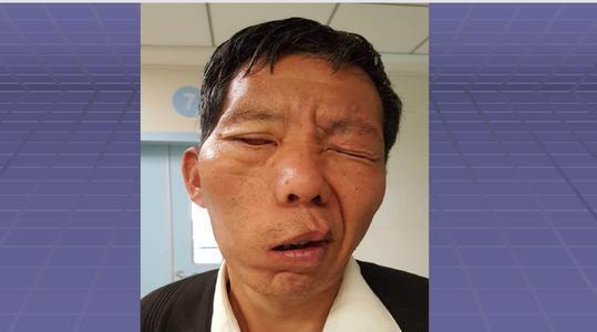 运动功能障碍为主要特征的一种常见病,导致这样的情况,很可能是脑中风