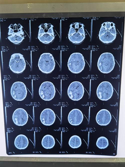 患者:巴德尔苏德,男,57岁,右侧颞顶枕叶脑出血,呈昏睡