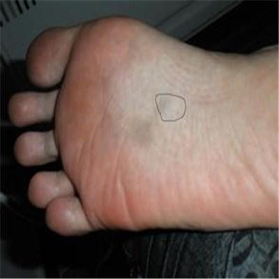 脚心疼是怎么回事