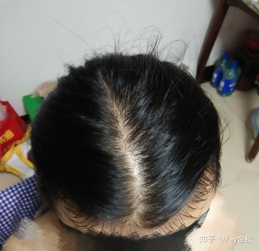 现在感觉头发一油就贴头皮,手稍微一抓就好几根掉下来,怎么办?