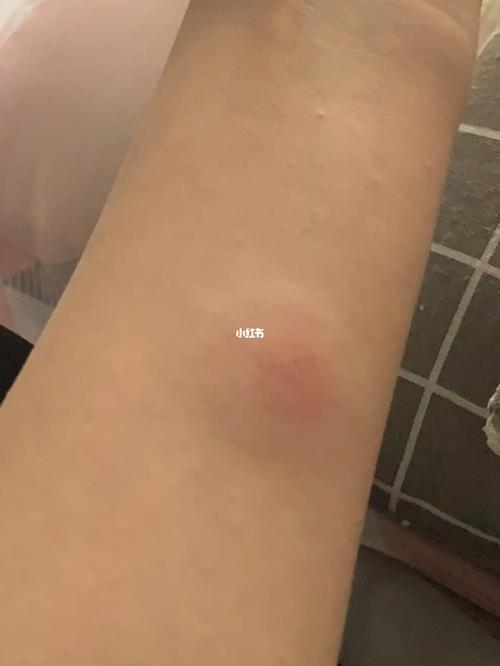 ppd皮试结果.到底是不是肺结核?