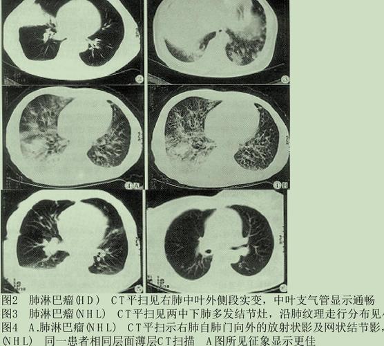 图22 或表现为网格状阴影,少数不典型的患者表现为弥漫性磨玻璃阴影.