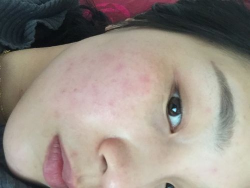 皮肤过敏,红血丝强烈推荐haba的沙烷油(美容油)