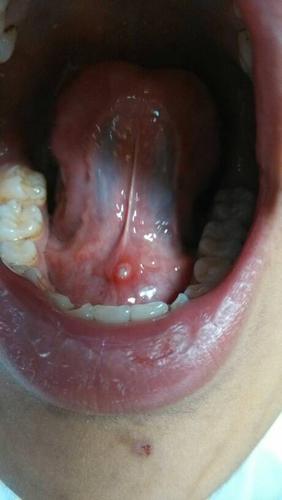 舌头下面长这个东西,很疼,这是什么?