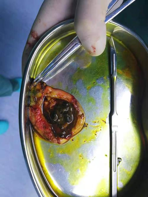 胆囊的生理功能是浓缩和贮存胆汁,所以胆囊切除后的短期内需低脂饮食