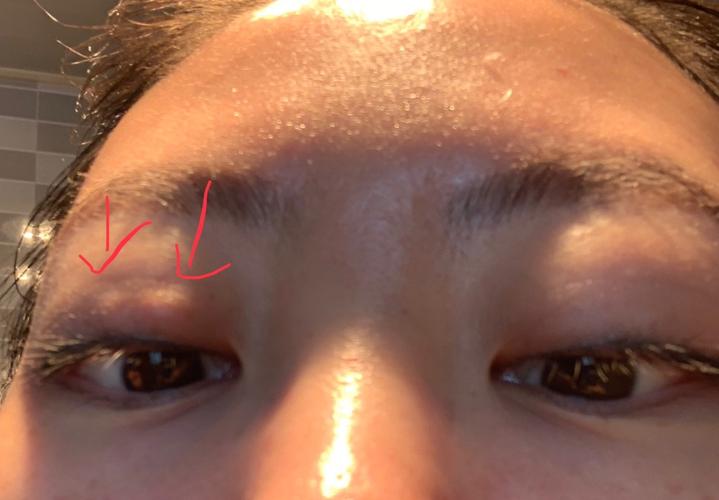 睑板腺囊肿,听起来有点恐怖_眼药水_消炎_美瞳_双眼皮