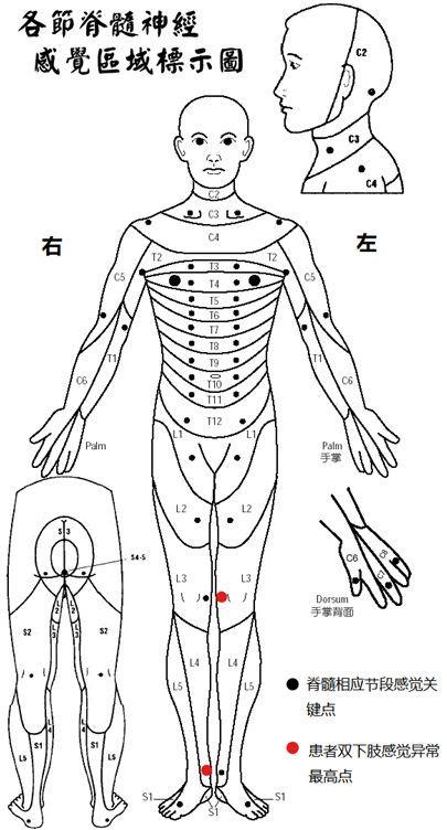 图示显示了患者运动双侧下肢感觉关键点(红点向下轻触觉及针刺觉减退