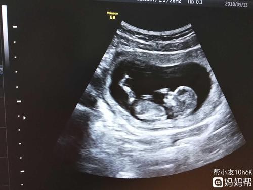 孕12周 ,nt检查看不到胎儿胳膊腿?