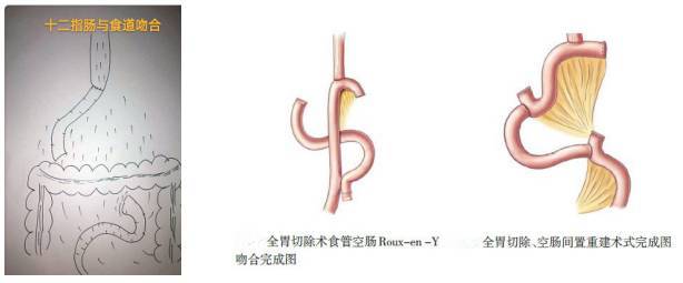 全胃切除,不连续间置空肠术"