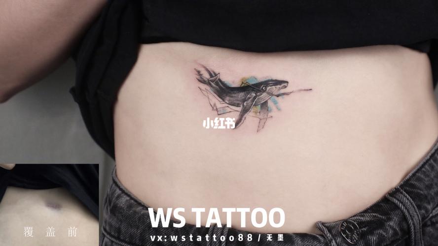 浙江纹身腹部疤痕遮盖