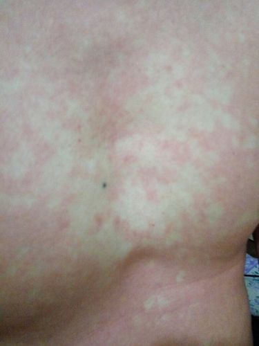 以前喝酒了都不会这样.今晚喝了10瓶啤酒就身上好多白点,手指按一下