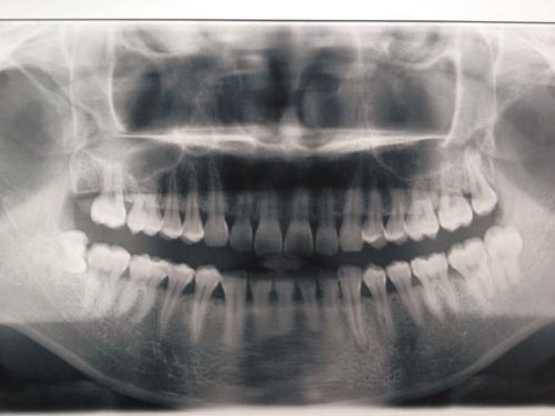 请专家帮忙看下牙齿x光图,右下的智齿是否需要拔除?