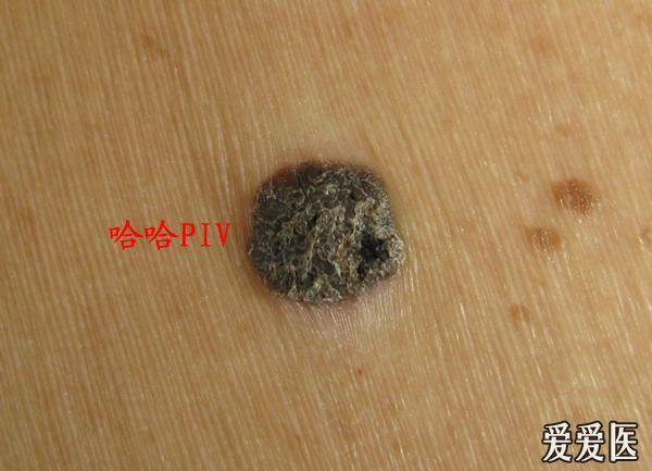 (脂溢性角化症)