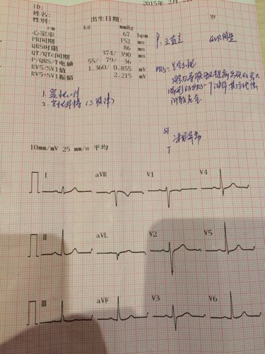我22岁,女,心电图结果是:心室率67bpm pr 间期 152ms