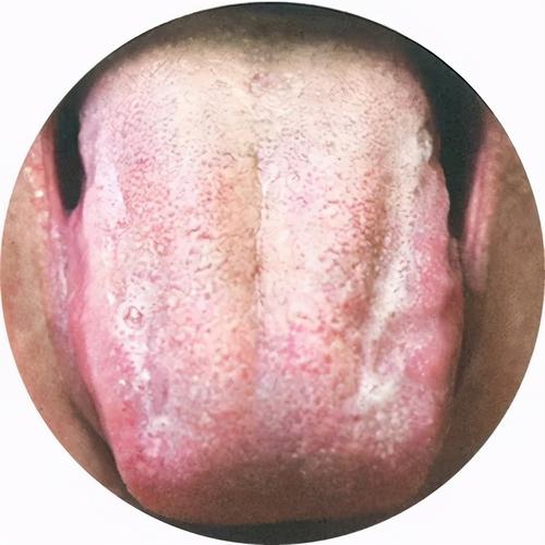 中医养生:零基础学舌诊(第八讲:痰湿体质典型舌象)