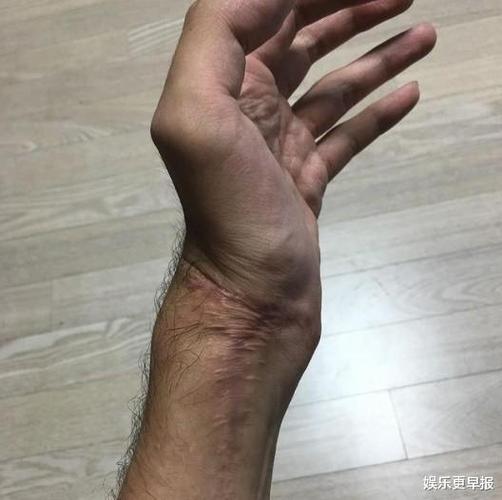 李铢衔2015年被玻璃门压断左手,造成手腕组织坏死,还差点截肢.