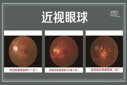 孩子近视眼每年增长200度?不抓紧治疗后果很严重