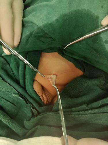 患者,男,3岁 左斜疝 于2019年5月15日在基础麻醉下行疝囊高位结扎术